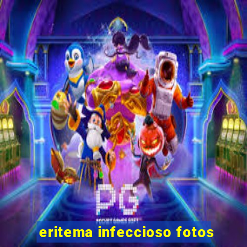 eritema infeccioso fotos